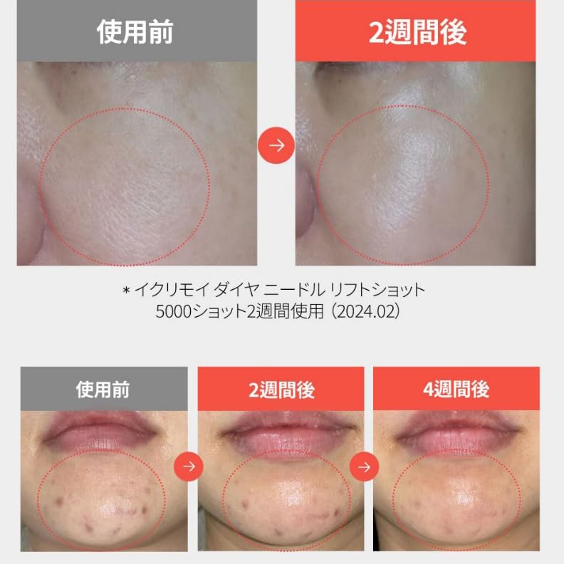 新品未開封ECLIMOI イクリモイ　まとめ売り Amazon.co.jp: ECLIMOI(イクリモイ)ダイヤリフトショット1000 毛穴