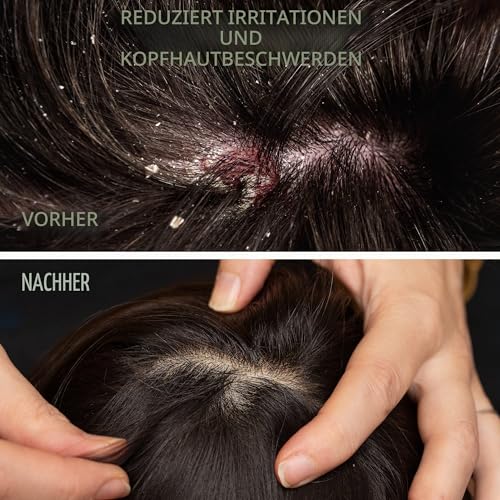 Milva Kiefer-Teer Shampoo gegen Seborrhoische Dermatitis – 500 ml Natürliches Anti-Schuppen Shampoo – Psoriasis Shampoo – Pflege für trockene, juckende und schuppige Kopfhaut