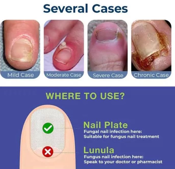 Nozti Anti Paronychia Relief Oil, 10ml, Natural Nail Treatment for Pain Relief and Disinfection - Image 4 thumbnail