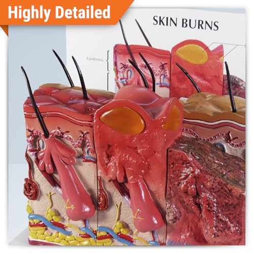 Image of GPI Anatomicals Skin Burn Model, Cross-Section Model Showing Burnt Skin | Human Body and Anatomy Replica for Physiology Education, Anatomical Model for Doctor's Office, Medical Learning Resources