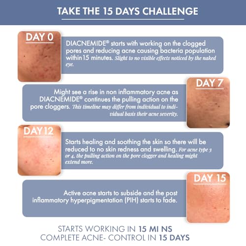 Image of ThriveCo Acne-Free Sun Defense Kit | Sunscreen (30ml), Anti-Acne Serum (10ml) & Face Wash (25ml) | Treats Acne, & Acne Marks | SPF 50 PA++++ | Zero White Cast | Travel-Friendly | For Men and Women
