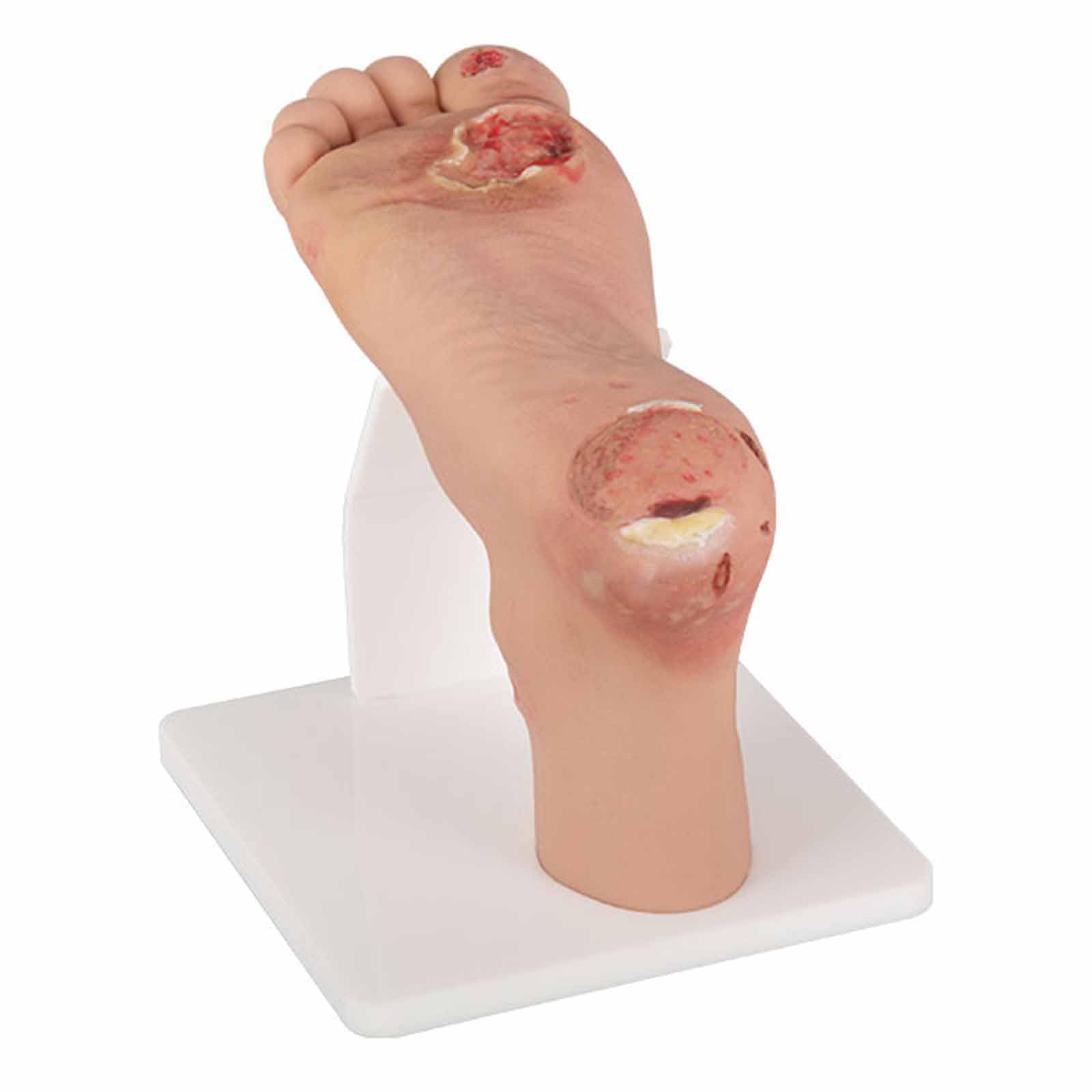 YRQMGSF Diabetic Foot Care Model Foot Pathology Model Medical Foot Ulcer Model for Foot Deformity Teaching Aid,Mild,15cm