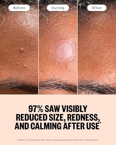 PEACE OUT Early Stage Acne Dots — view 4