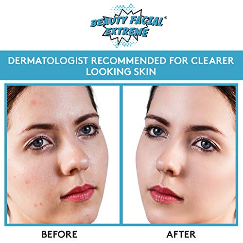 Acne Spot Treatment Serum - Quickly Fights And Treat Acne Breakouts, Pimples, Whiteheads & Blackheads. Dissolves Away Pore Clogging Oils Without Over Drying Your Skin. #TOP2