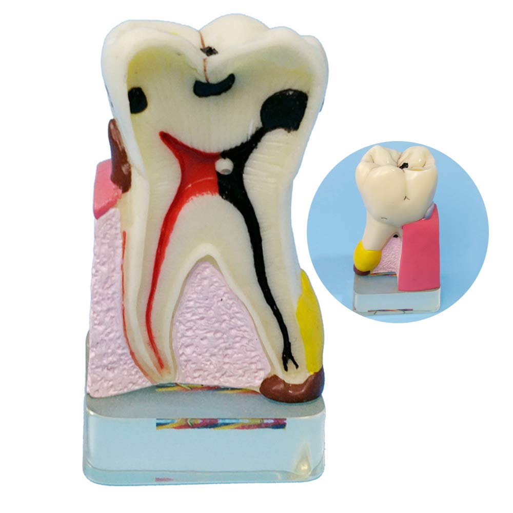 Sjdopulse Light Dental Pathology Model - Dental Teeth Model - Implant Analysis Demonstration Periodontal Disease Assort Teeth Gums Model - Teeth Gums Standard Demonstration Tool