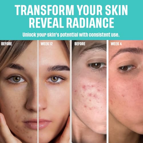 Amour de Moi 2% BHA AHA Liquid Salicylic Acid Exfoliant - Gentle Peel, Pore Minimizer, Face Exfoliator for blackheads, wrinkles with Hyaluronic acid - Fragrance-Free Hydrating for All Skin Types, 2oz