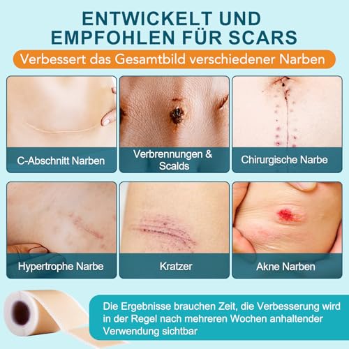 Silikonpflaster für Narben (4cm x 190cm) – Wiederverwendbare Silikon-Narbenblätter, hautfreundlich & haftstark – Wasserdicht & für alle Hauttypen