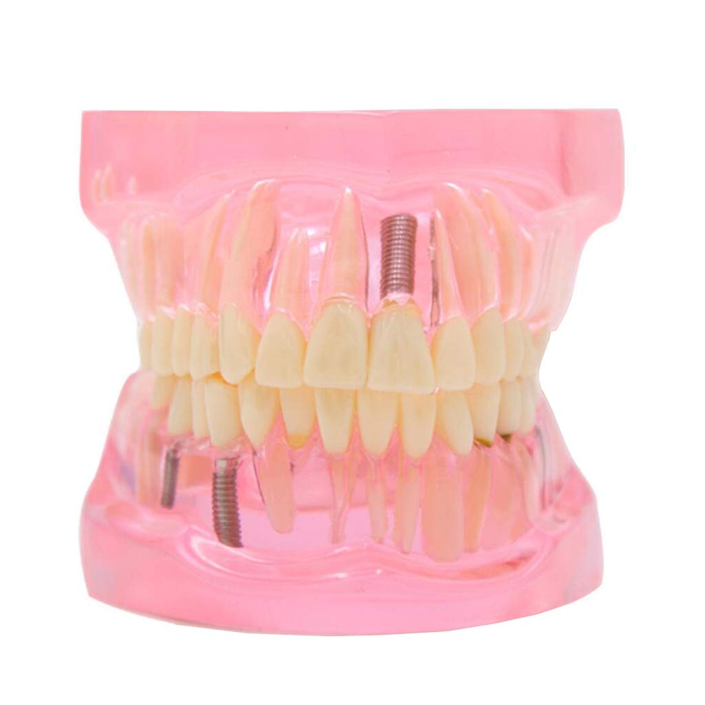 Modello Anatomico dei Denti - Modello di Dente per Addestramento alle Operazioni Ortodontiche Staccabili Trasparenti - per Aiuti allo Studio Educativo Medico, Attrezzature da Laboratorio