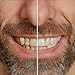 Bright White Smiles 44% Whitening Gel – 20 Syringes(3ml) – Fast-Acting Carbamide Peroxide Teeth Whitener