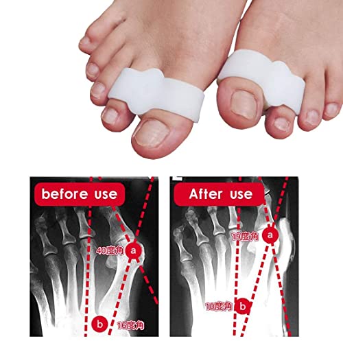 Image of 24 Pieces Toe Separators Bunion Corrector Toe Spacers with 2 Loops, Soft Gel Big Spacer Suitable for Bunion and Overlap