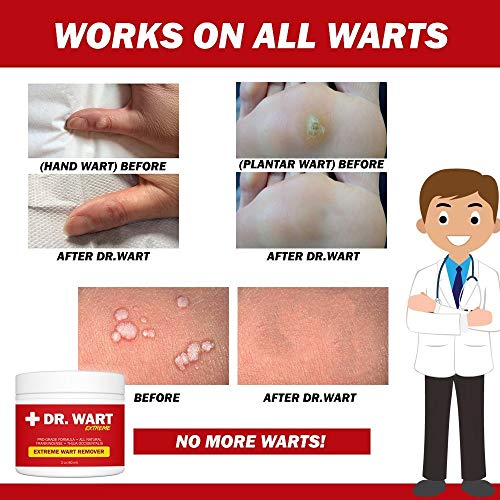 DR. WART Extreme Wart Remover Works on All Warts! Plantar Warts