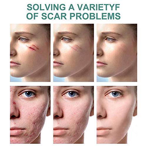 Scar Removal Cream, Scar Cream For Old New Scars, Stretch Mark Removal Cream, Acne Scar Removal, Burns Repair Cream, Acne Spots, Face Skin Repair Cream, Natural Scar Treatment For Face & Body 50G #TOP6