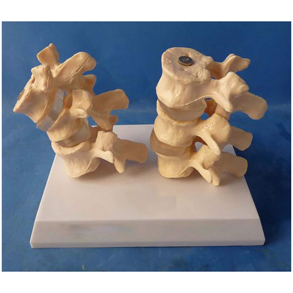 Sjdopulse Diseased Lumbar Comparison Model - Human Lumbar Model - The Diseased Model Of Vertebrae - Medical Anatomical Spine Model - For Medical Educational Training Aid