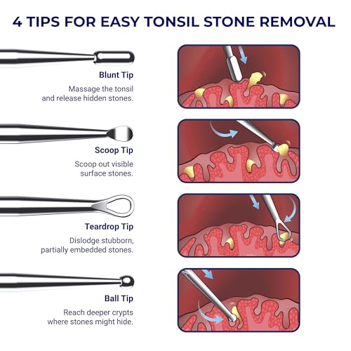 Oravix Metal Tonsil Stone Pick
