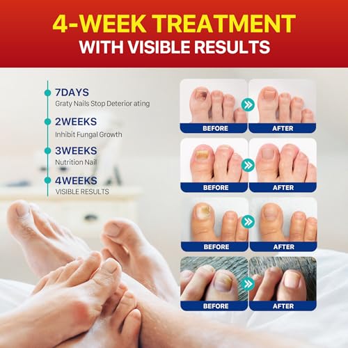 Umaeost Toenail Fungus Treatment For Nail Repair: Toenail Fungus Treatment Extra Strength For Altheles thumb #3