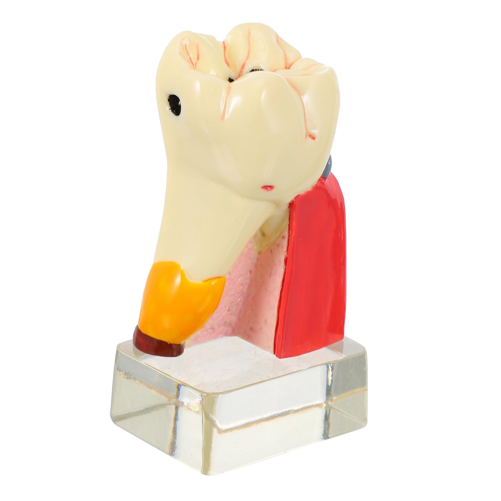 Modello Anatomico di Carie Dentale 4x in Resina Beige, Didattico | Dimostrazione e Insegnamento, Leggero e Portatile, per Odontoiatra, Uso Professionale in Studio