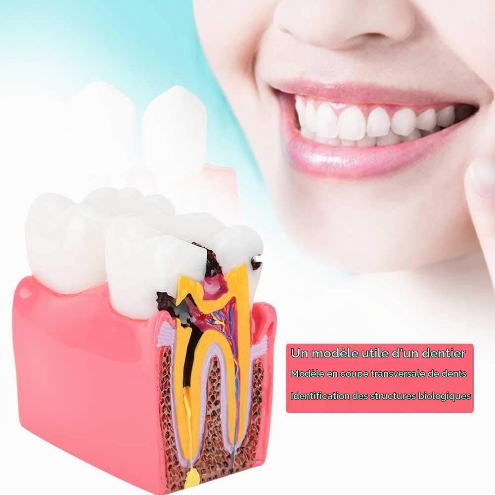 Agatige Modèle D'anatomie Dentaire, Modèles D'Étude De Comparaison De Caries Modèle De Dents D'Éducation À L'anatomie Dentaire De Dentiste Modèle De Développement De Caries Dentaires pour L'Éducation