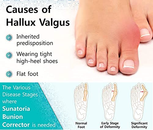 Image of Toe Separator for Feet Toe Spacers Correct Toes Yoga Silicone Hammer Toe Corrector for Women & Men Correct Toe Straighteners for Overlapping Toes (All Finger Toe Separator) (MAX +)