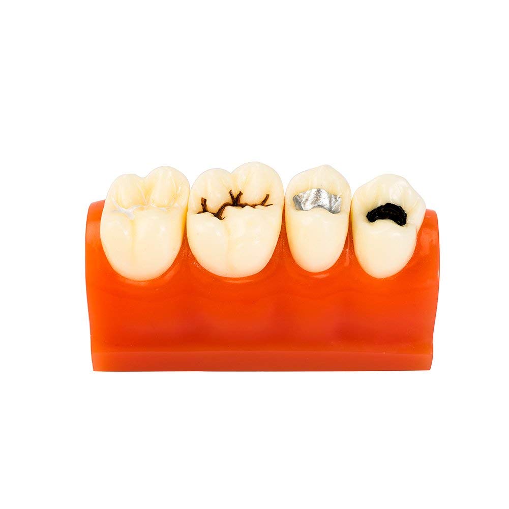 Modello di denti dentali per allenamento orale, chiusura a fessura e scanalatura, strumento educativo per anatomia umana, studio medico e simulatore di pratica