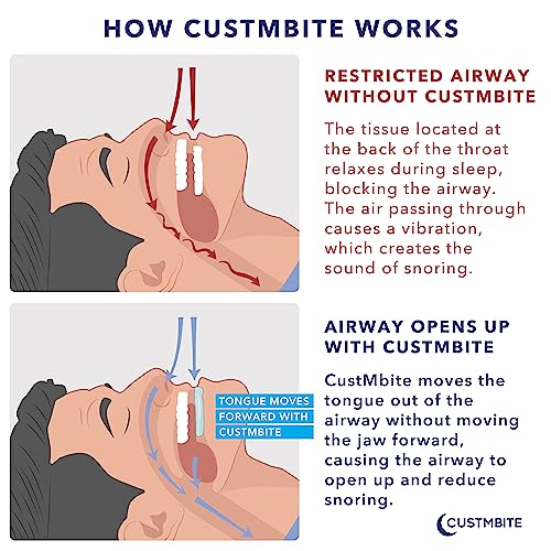 Custmbite Snoring System: Reduce Snoring With Snore Reducing Devices - Snoring Solution For Men And Women, Helps Prevent Snoring #TOP2