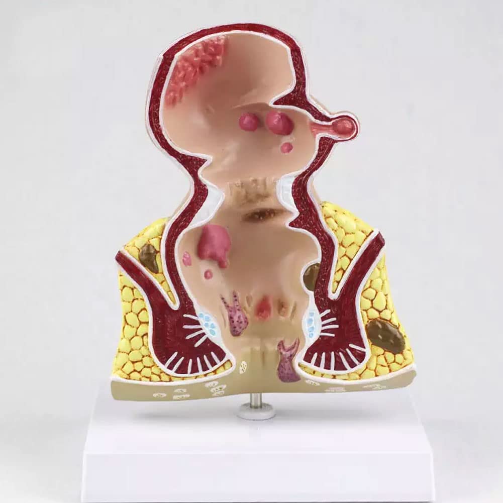 Model Odbytnicy Człowieka Odbytnicy Model Powiększenia Zmian Patologicznych Model Rozszerzenia Układu Trawienia Anatomia-Modele Medyczne Materiały Edukacyjne