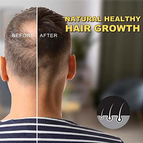 Pefamne 5% Minoxidil For Men And Women Hair Growth Oil thumb #4