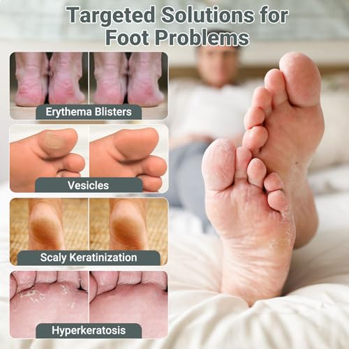 Image of ishancare Extra Strength Antifungal Foot Cream (0.7oz) - Natural Herbal Treatment for Athlete's Foot - Relieves Itching, Burning, Cracking & Fungal Infections