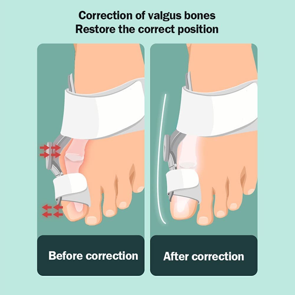 Separador Dedos Pie Juanetes Mujer y Hombres, Separador dedos pie para El Alivio Del Dolor Hallux, Alta Eficiencia para Corregir y Aliviar Dolor de Juanes