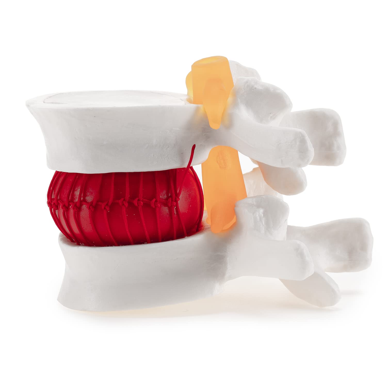 Winyousk Human Intervertebral Disc Herniation Model, eEducational Display Tool, Anatomical Model of Lumbar Disc Herniation, Medical Teaching and Learning Model