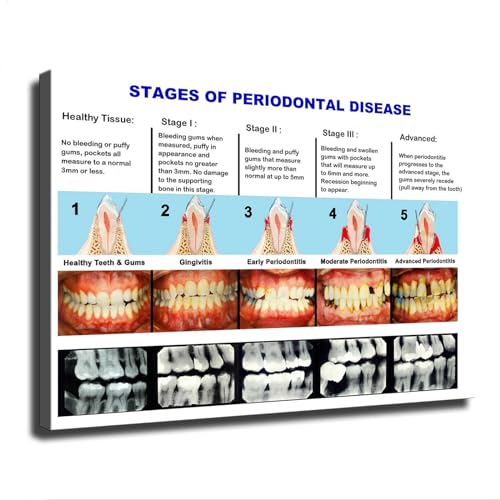 Dental Clinic Wall Poster Periodontal Disease Staging Chart Poster Modern Family Bedroom Office Background Wall Art HD Picture Canvas Printing Artwork Decor (16×24inch-No Framed)