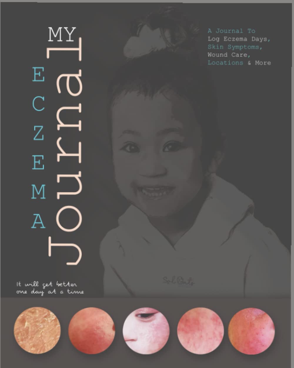 Amazon.com: My Eczema Journal: Log Eczema Days, Skin Symptoms, Rash ...