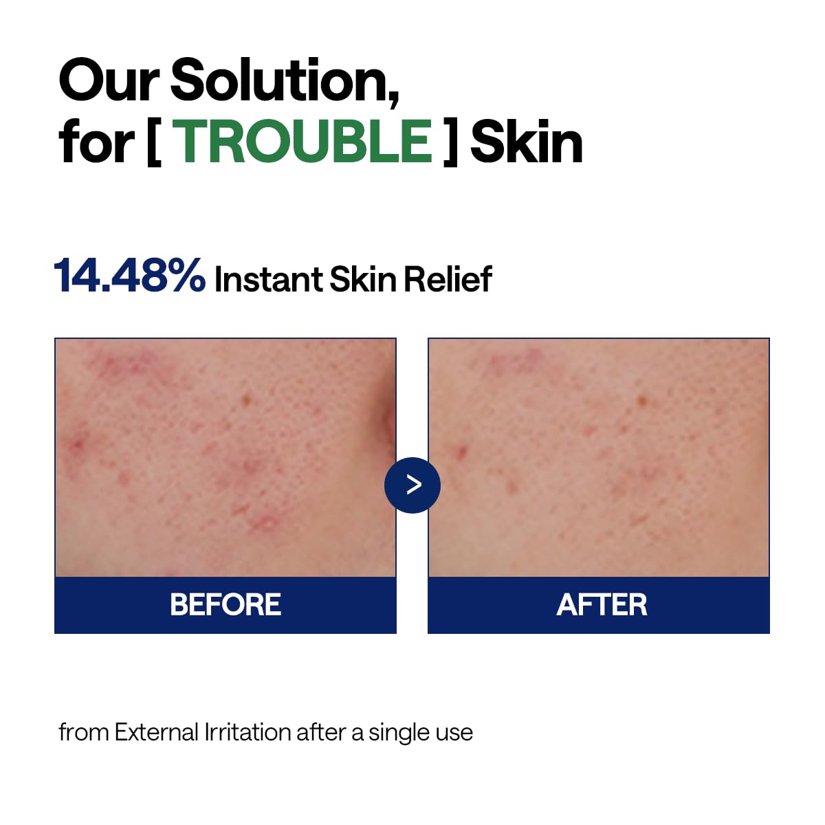 Mediheal Teatree Calming Serum 1.35 fl.oz - Quick Skin Calming and Redness Relief - Sebum Care, Oil Moisture Balance & Deep Moisturization with Hyaluronic Acid - Image 6