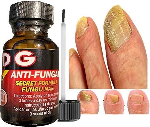 Miniatura 2 de Hongos Uñas Tratamiento para Eliminar Onicomicosis y Mantener Uñas Saludables