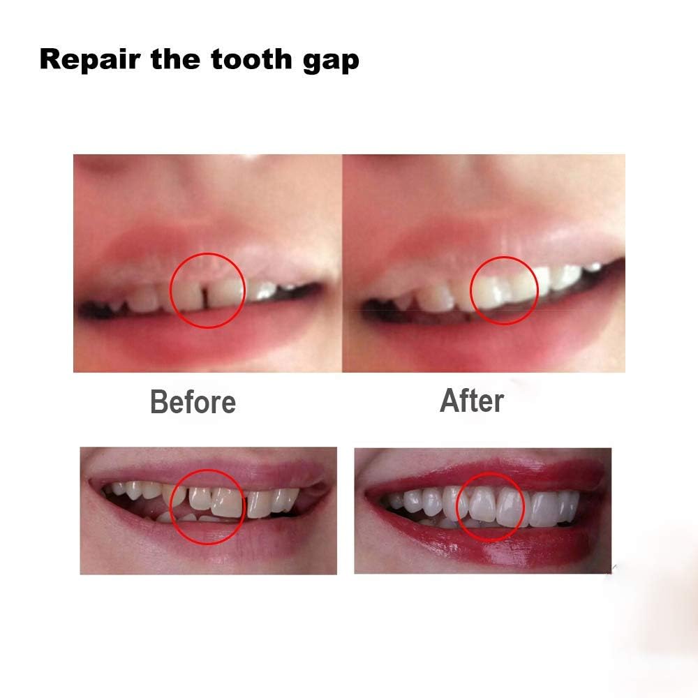 Cuentas térmicas de relleno de dientes, hazlo tú mismo, dientes falsos moldeables para reparación temporal de dientes, kit de reemplazo de dientes perdidos y rotos (paquete de 2) 3