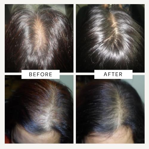 Image of Richfeel Anagrow Advanced Hair Regrowth Serum - A Swiss Formula • Controls Hair Fall • Stimulates Regrowth • Boosts Density • Lightweight Formula (2x15ml)