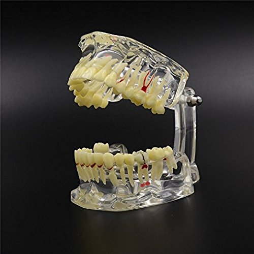 Pathology Teeth Model Dental Study Teeth Transparent Adult Pathological Removable Gingivae Pathology Teeth Model Used in Teaching,Explain,Studying for Adult(Transparent)