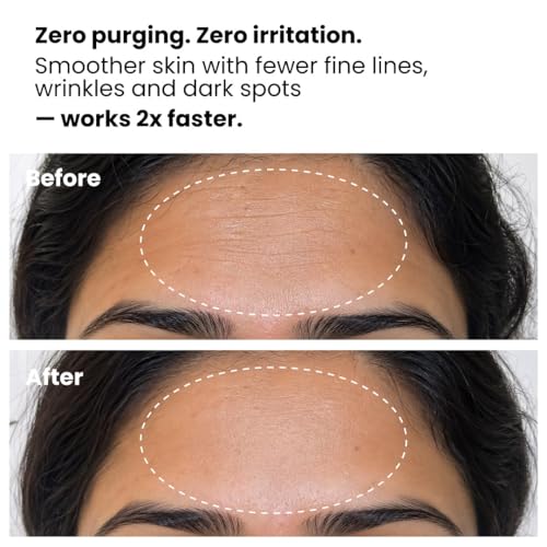Image of Foxtale 0.3% Retinol + Ferulic Acid Serum | Targets 8 Signs of Ageing | Boosts Collagen, Firms Skin, Fades Dark Spots, Reduces Fine Lines & Wrinkles | For Intermediate & Advanced Users