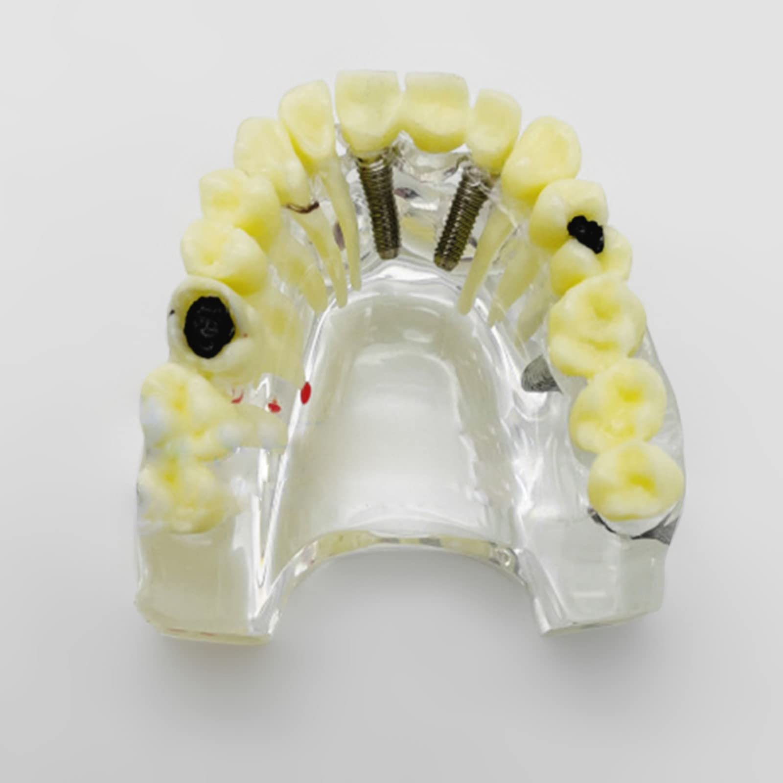 Modelo De Ortodoncia Dental Tipodonte/modelo De Restauración Dental De Modelo De Restauración De Prótesis 303948498626