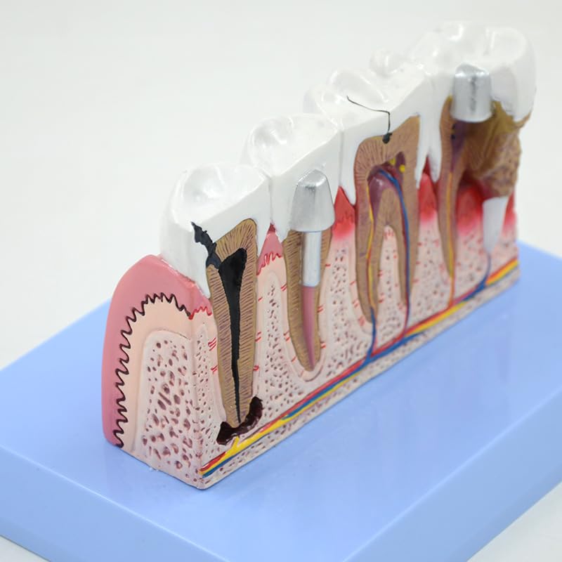 Dente Dentale Patologia Modello Anatomico Scienze Mediche Risorse Didattiche Dropshipping