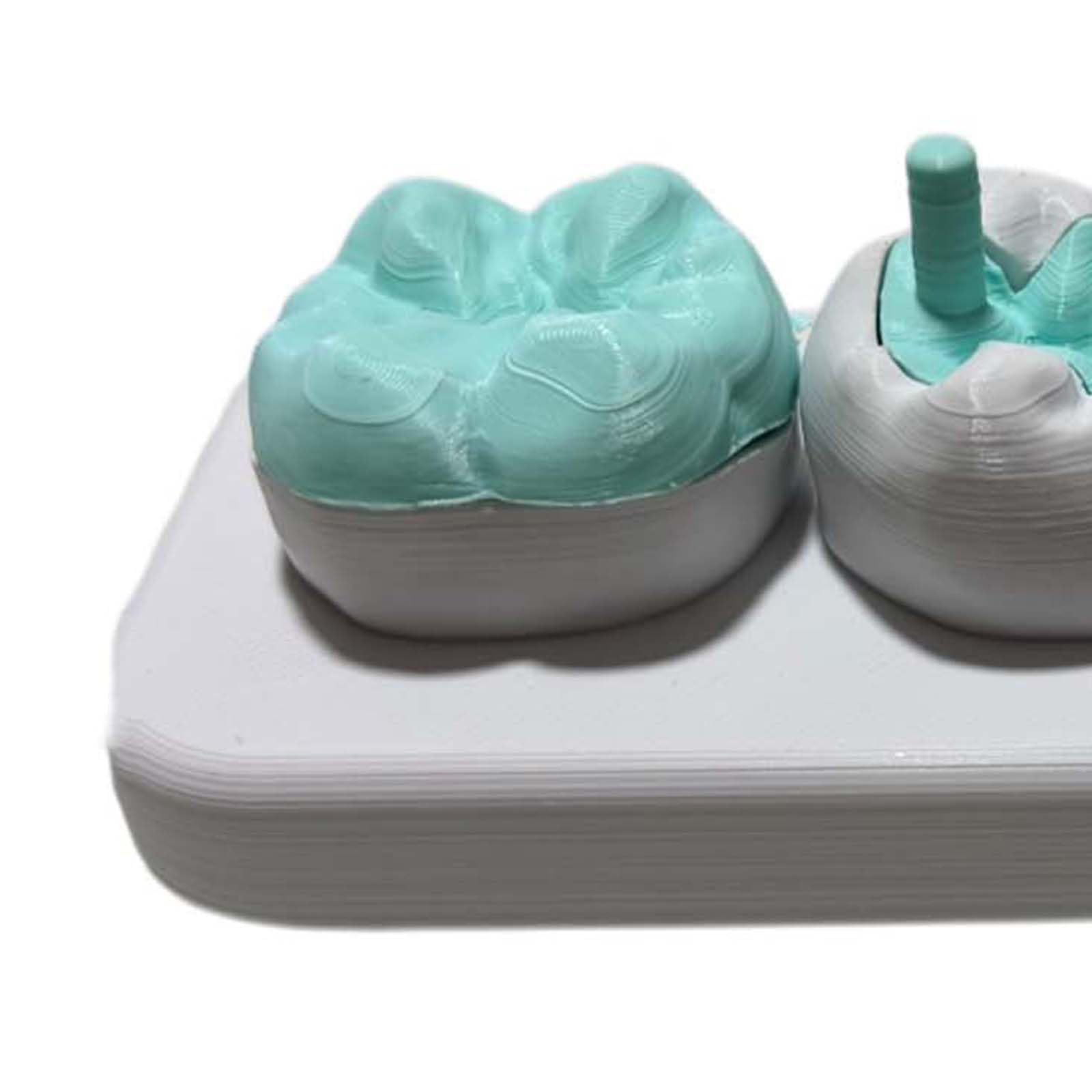 Modello di Intarsio e Onlay, Modello Didattico di Corona Completa con Attacco Magnetico, per la Comunicazione Dentista-Paziente