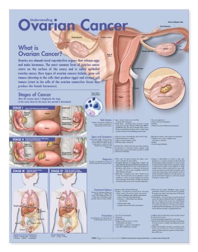 Ovarian Cancer Chart