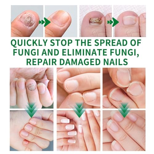 2PCS Ginger Nail Treatments,Nail Treatment,Ginger Nail Growth Serum - Image 6