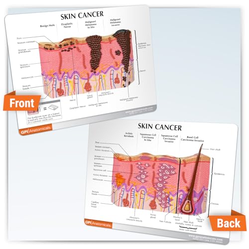 Image of GPI Anatomicals Skin Cancer Model, Skin Replica with Melanoma and Carcinoma | Human Body and Anatomy Replica for Physiology Education, Anatomical Model for Doctor's Office, Medical Learning Resources