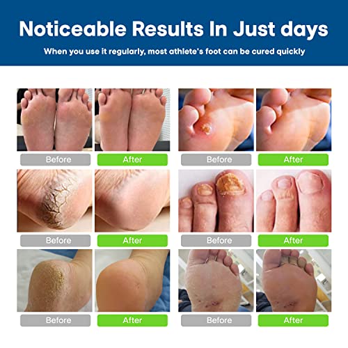 CHARMPOO Antifungal Cream Athletes Foot Antifungal