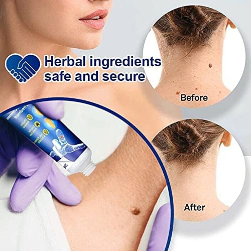 Best Instant Blemish Removal Gel, Skin Tag Remover Cream, Wart Removal Body Warts Treatment Cream Foot Care Cream Skin Tag Remover, Wart and Callus - Effective and Scar-Free