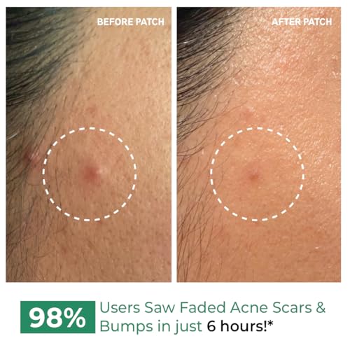 Image of Conscious Chemist Self Dissolving Microneedle Acne Patches (Pack of 8 Patches) | Painless & Effective Pimple Patches with 2% Salicylic Acid, Azelaic Acid & Niacinamide | Kills Bacteria, Reduces Redness, Scarring & Excess Sebum | Visible Results in 6 Hours