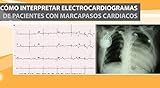  Como Interpretar Electrocardiogramas de Pacientes con Marcapasos Cardiacos