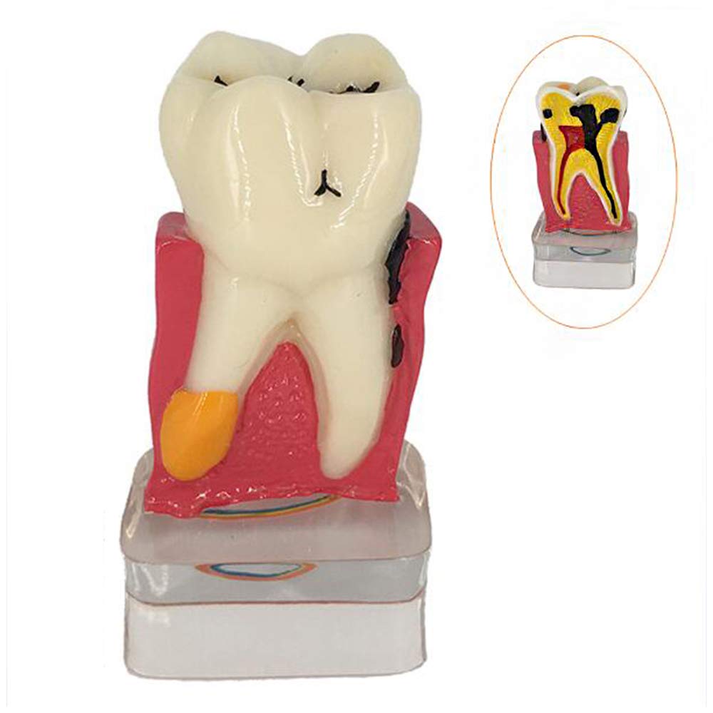 Modèle D'Implant Dentaire – Modèle Anatomique des Dents – Modèle D'Étude des Soins Dentaires – Modèle De Dent De Démonstration en Coupe Transversale