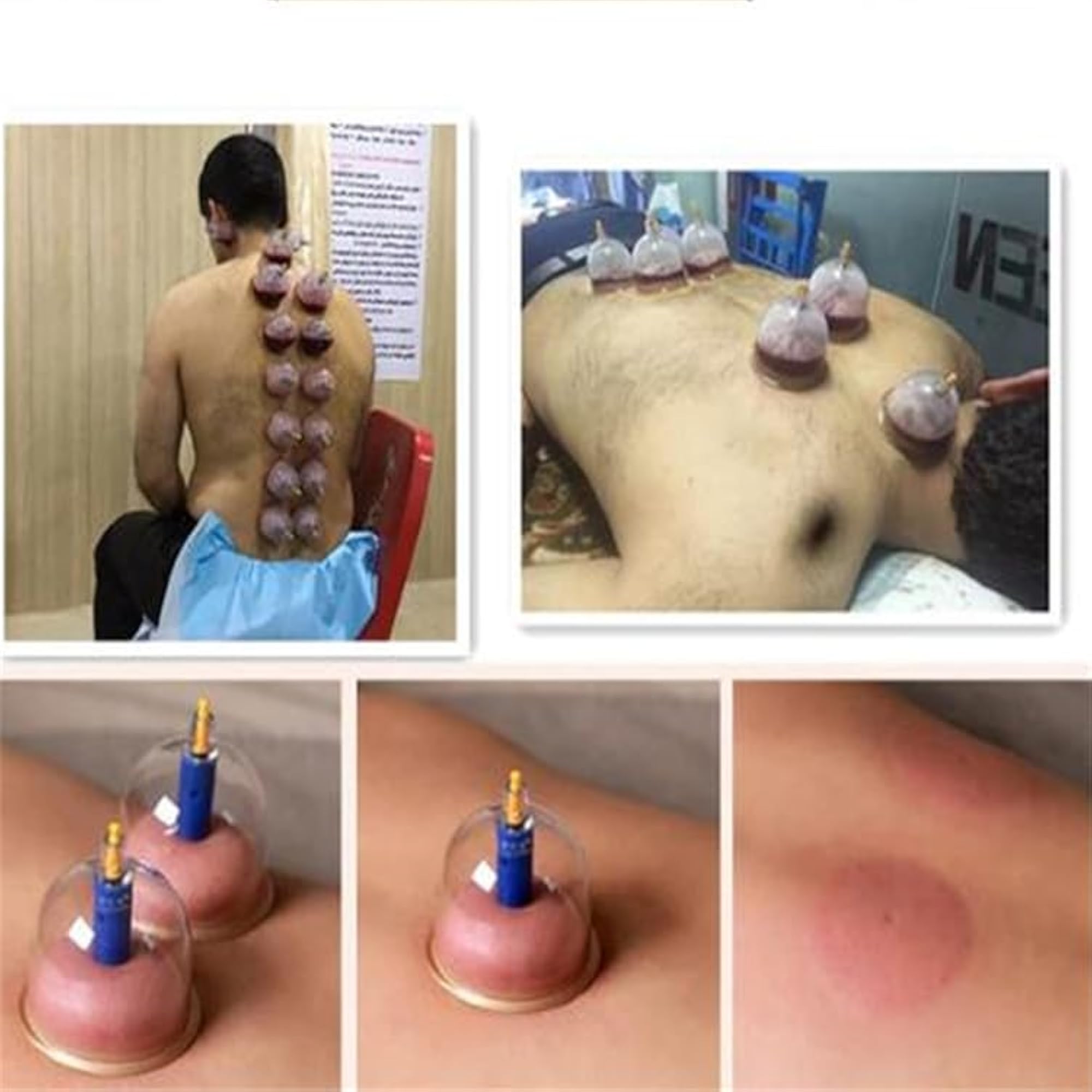 Vacuum Cupping Apparatus, Single Cupping Pump