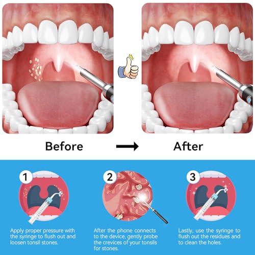 Tonsil Stone Remover with Camera